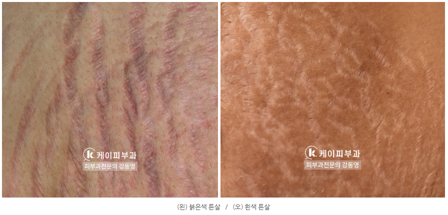 부산 해운대 센텀 튼살레이저 치료_03.jpg