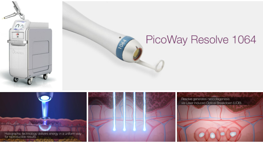 부산 해운대 센텀 튼살레이저 치료_06.jpg