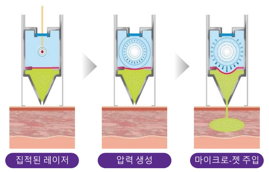 부산 이마, 미간 흉터레이저 후기 _05.jpg