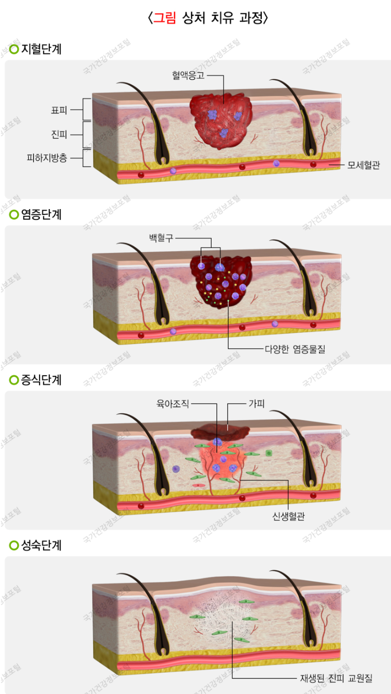 부산 이마, 미간 흉터레이저 후기 _01.jpg