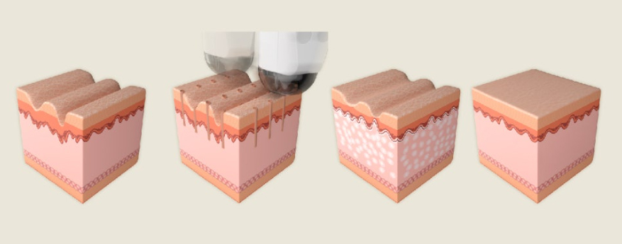 부산 이마, 미간 흉터레이저 후기 _04.jpg