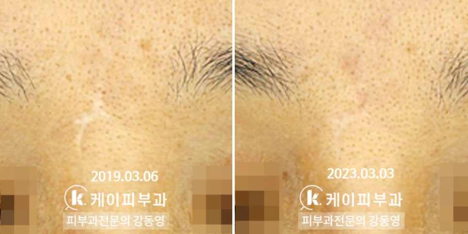 부산 이마, 미간 흉터레이저 후기 _02.jpg