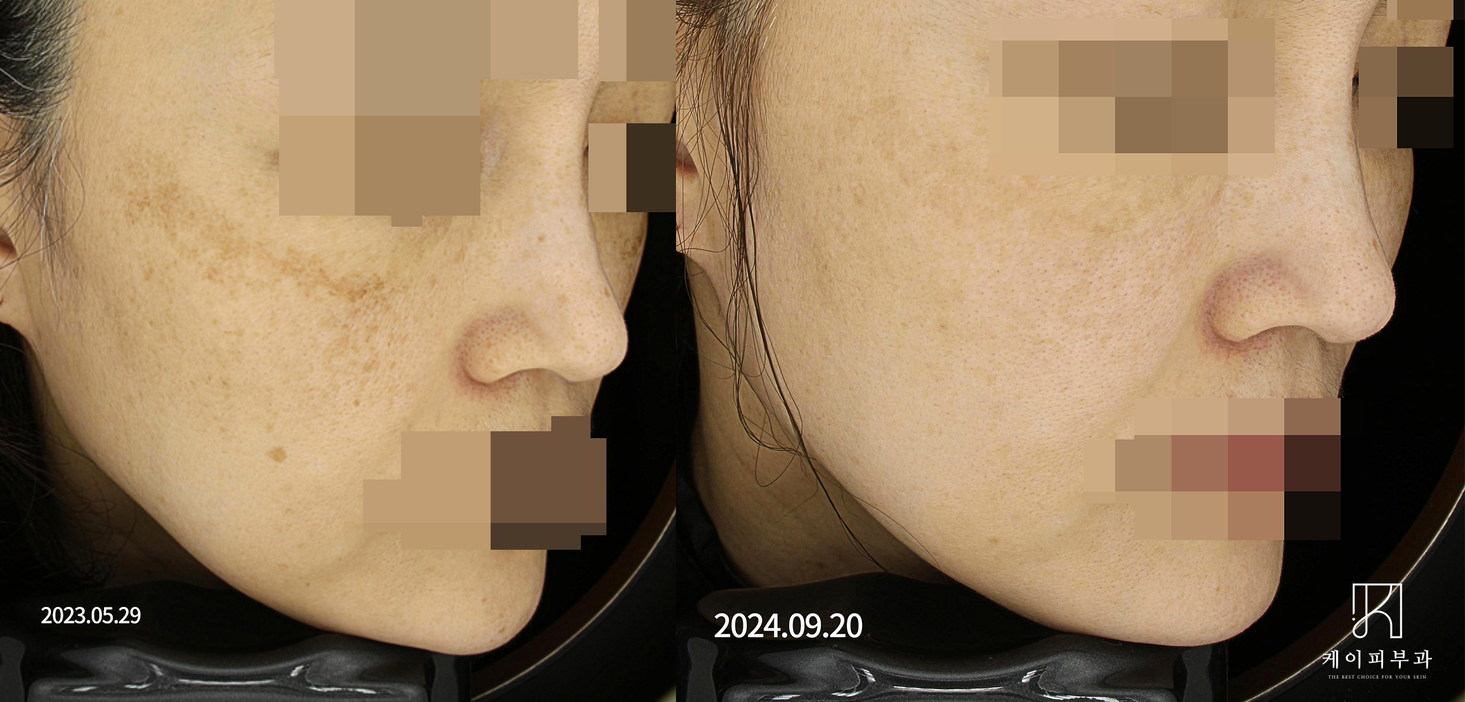 부산 해운대 눈밑 나이키기미(난치성기미)_01.jpg