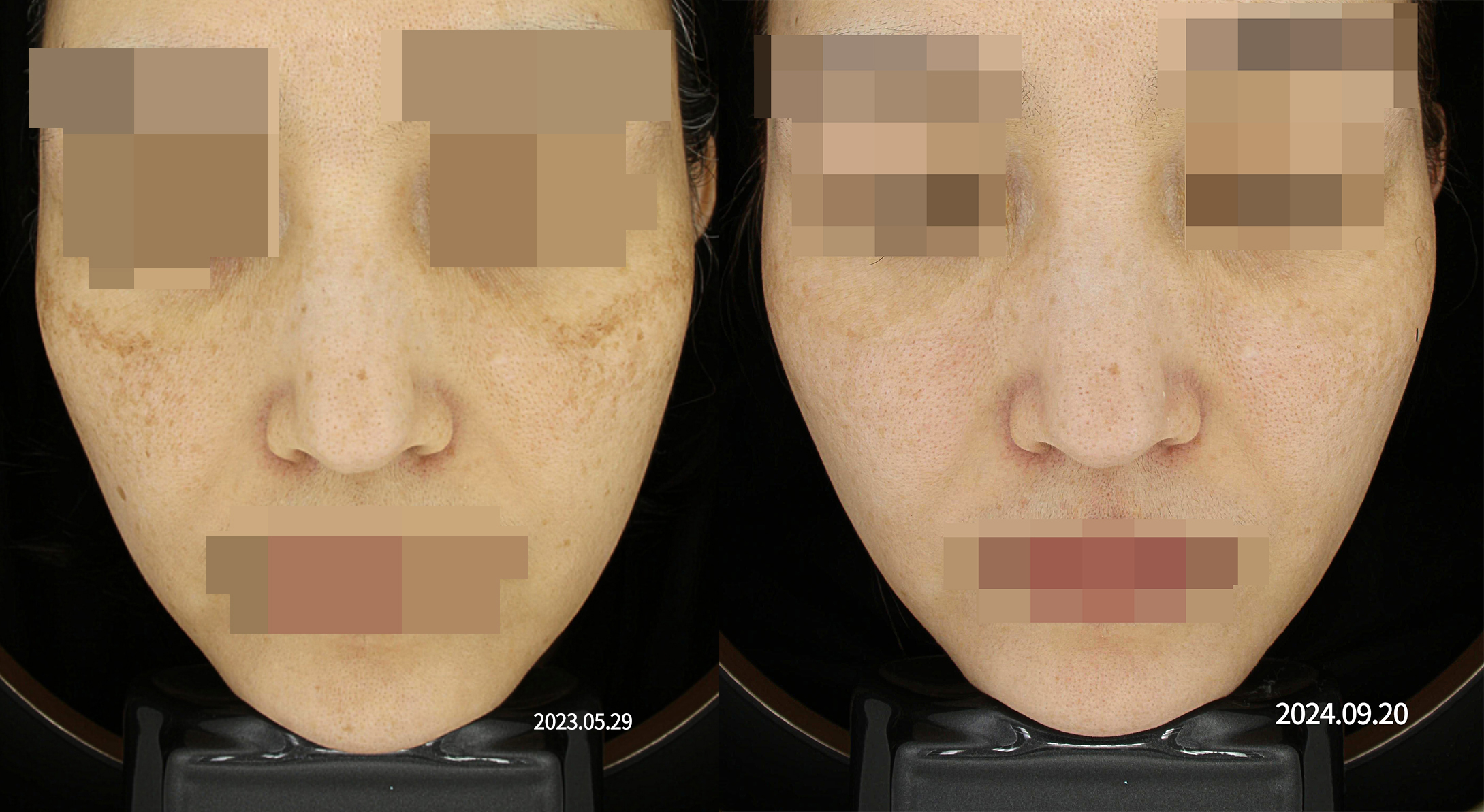 부산 해운대 눈밑 나이키기미(난치성기미)_03.jpg