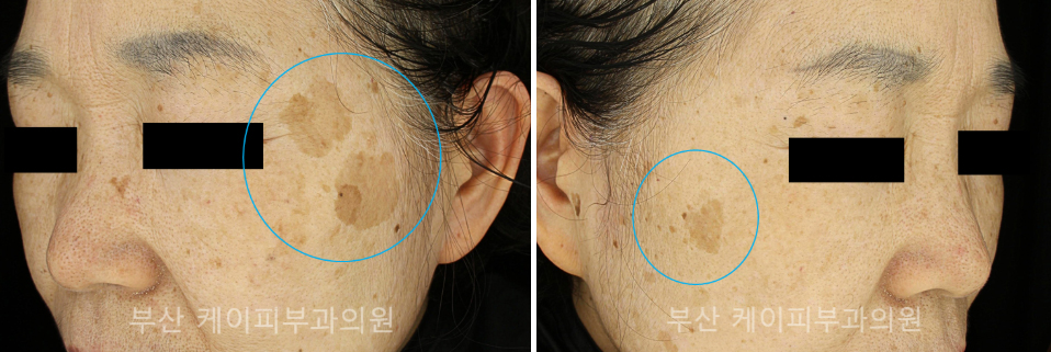 검버섯제거 레이저 치료_07.jpg