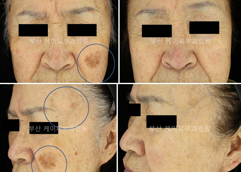 검버섯제거 레이저 치료_05.jpg