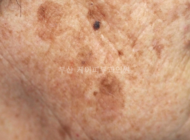 검버섯제거 레이저 치료_03.jpg