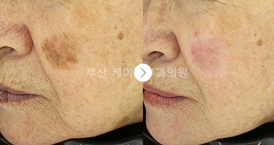 검버섯제거 레이저 치료_04.jpg