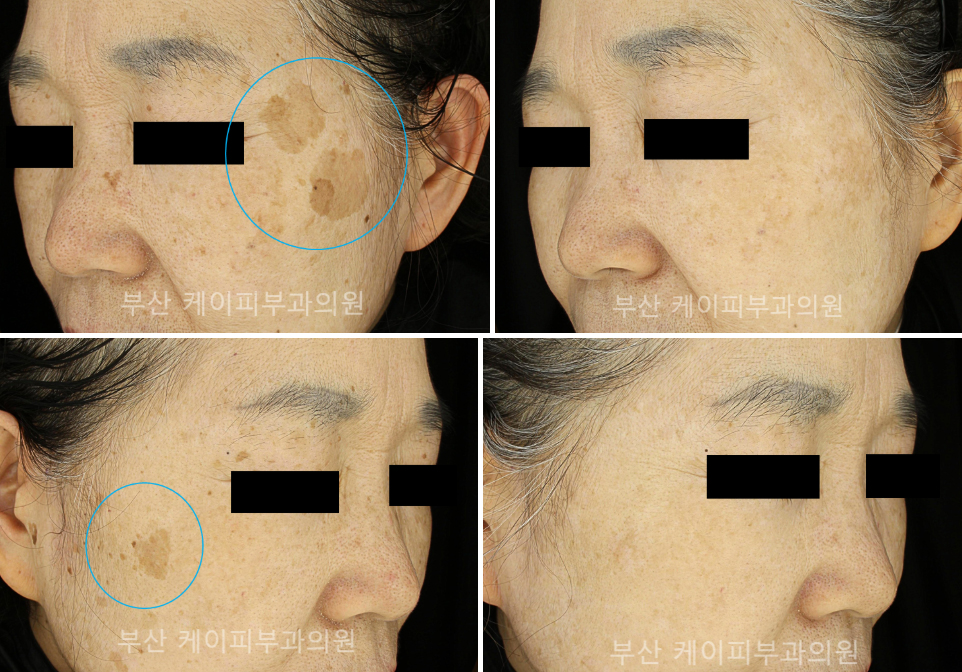 검버섯제거 레이저 치료_08.jpg