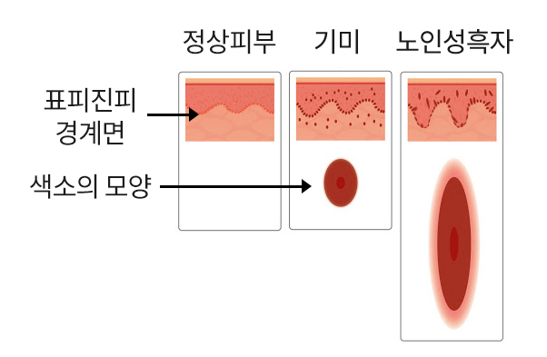 검버섯제거 레이저 치료_06.jpg