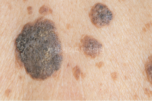 검버섯제거 레이저 치료_01.jpg