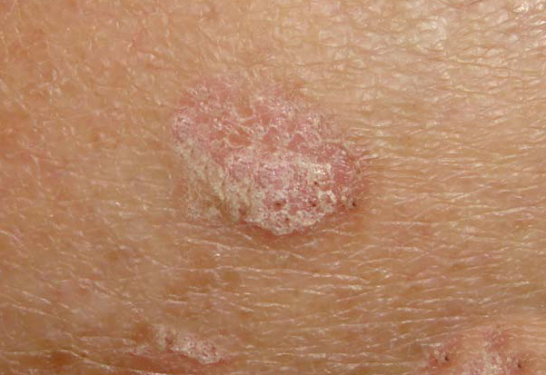 검버섯제거 레이저 치료_02.jpg