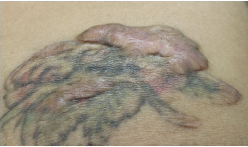 부산 문신제거_레이저치료 횟수_10.png