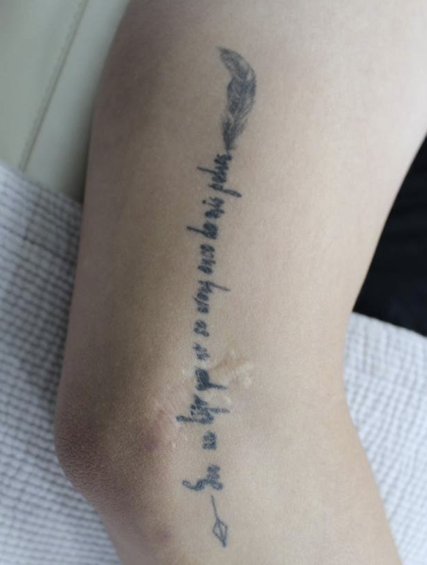 부산 문신제거_레이저치료 횟수_02.png