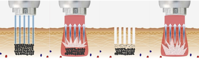 부산 문신제거_레이저치료 횟수_05.png