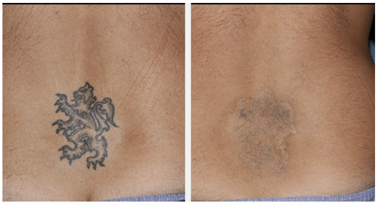 부산 문신제거_레이저치료 횟수_08.png