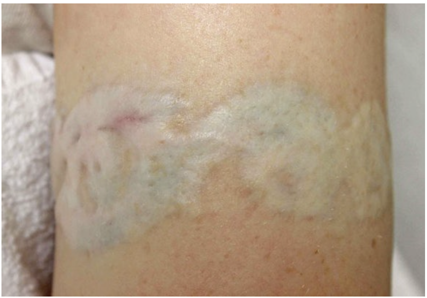 부산 문신제거_레이저치료 횟수_09.png