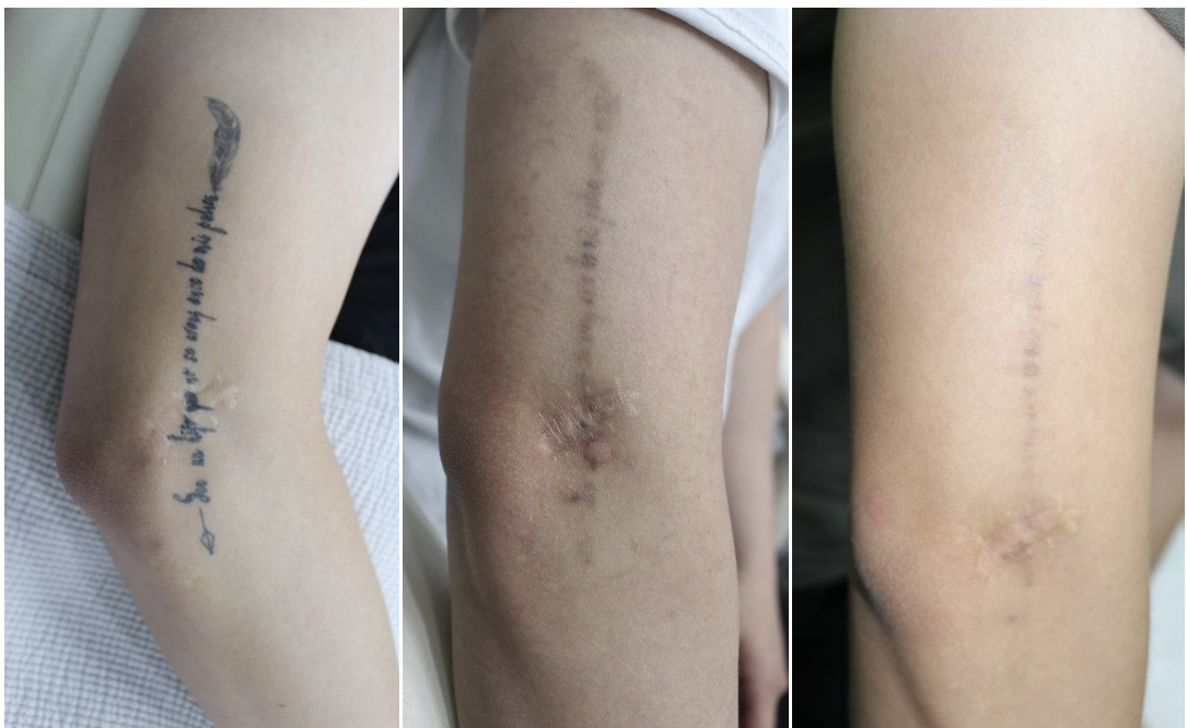 부산 문신제거_레이저치료 횟수_07.png