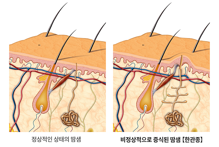 부산-눈밑-한관종(물사마귀)-Co2레이저,-아그네스-고주파_05.jpg