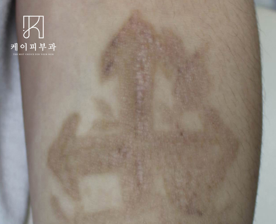 해운대 센텀 피코레이저 문신(타투)제거 후기_05_01.jpg