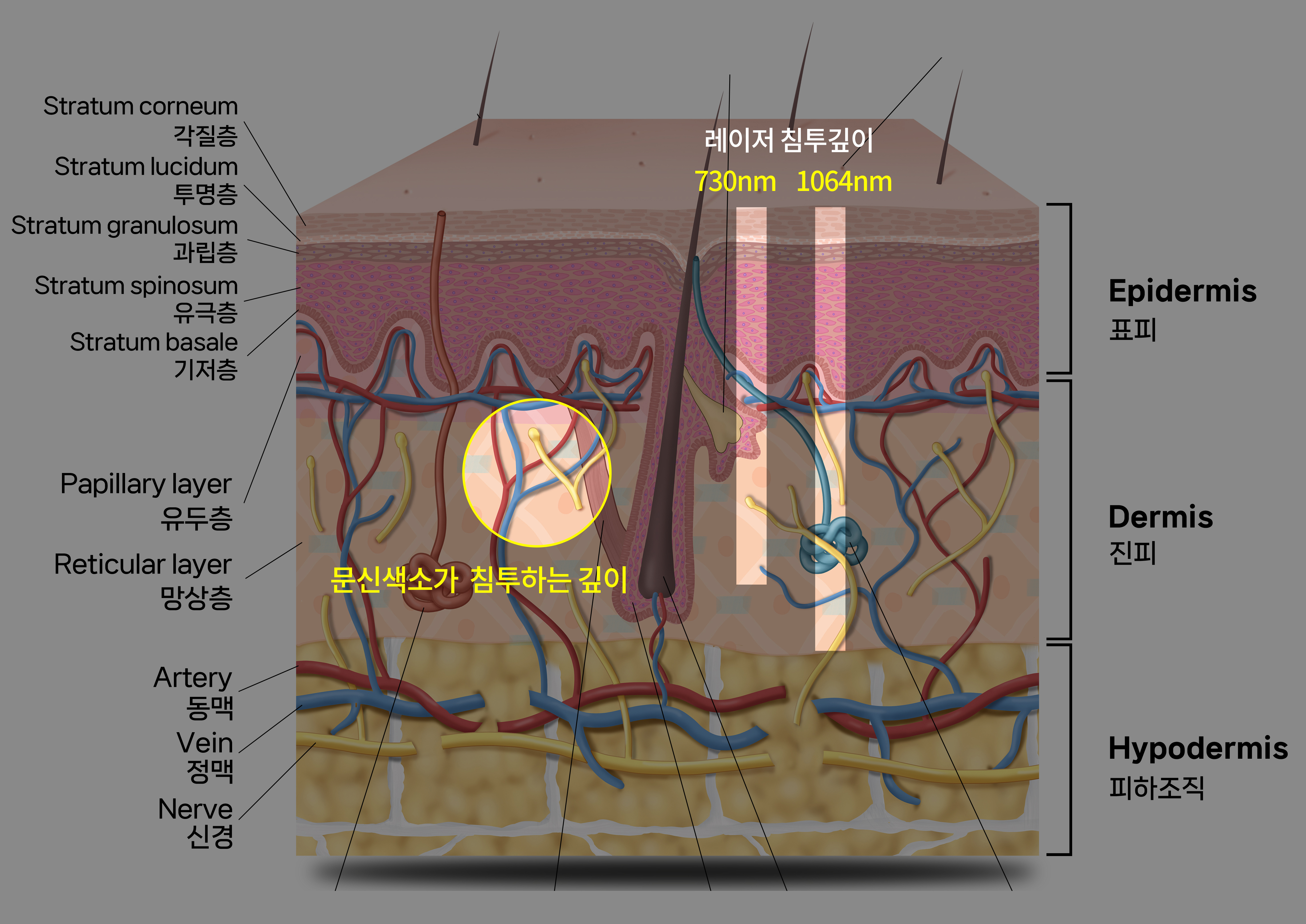 해운대 센텀 피코레이저 문신(타투)제거 후기_07.jpg