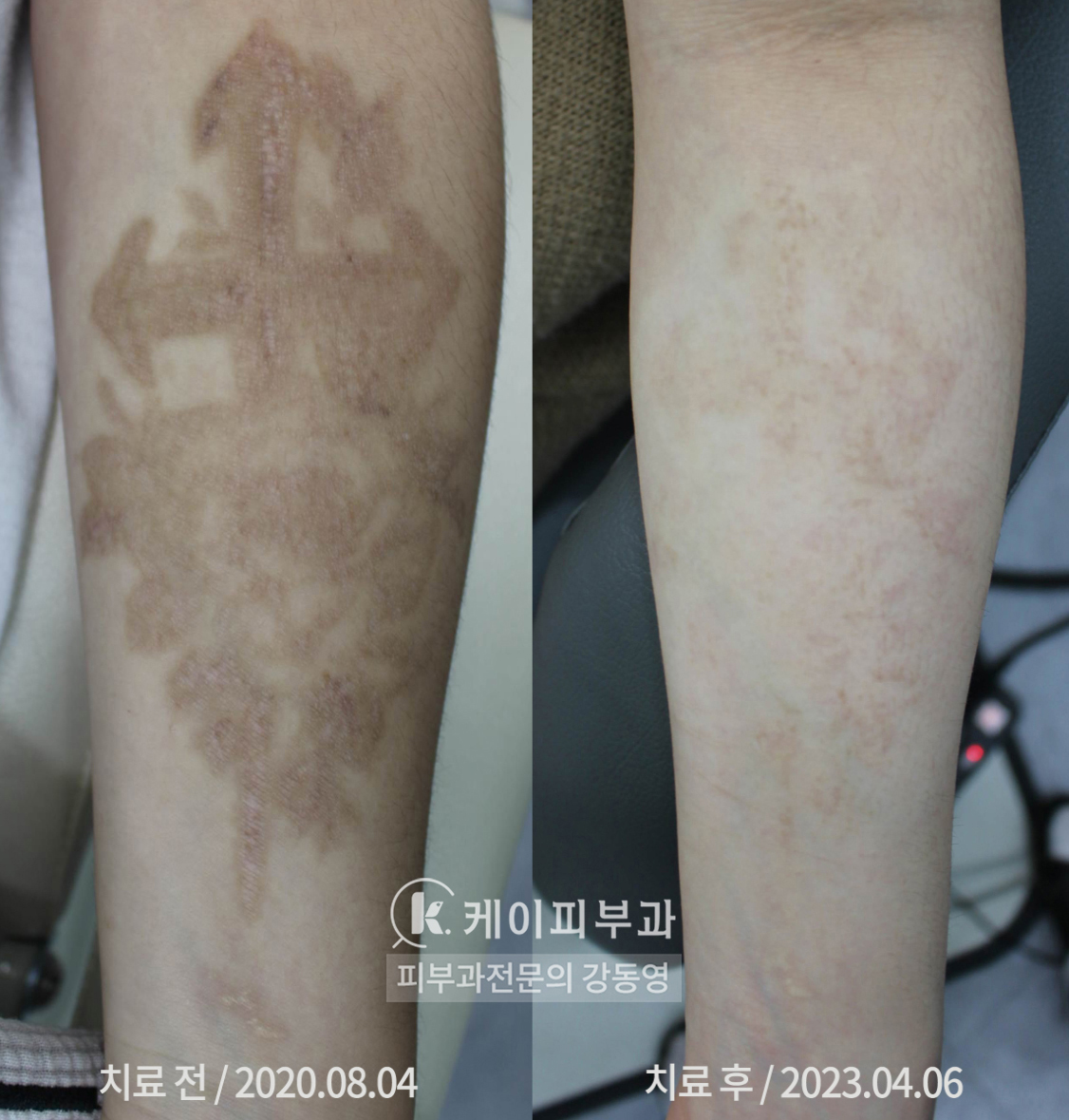 해운대 센텀 피코레이저 문신(타투)제거 후기_05.jpg