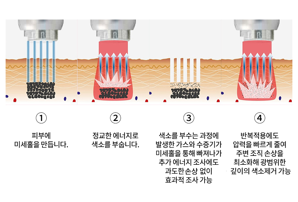 해운대 센텀 피코레이저 문신(타투)제거 후기_04.jpg