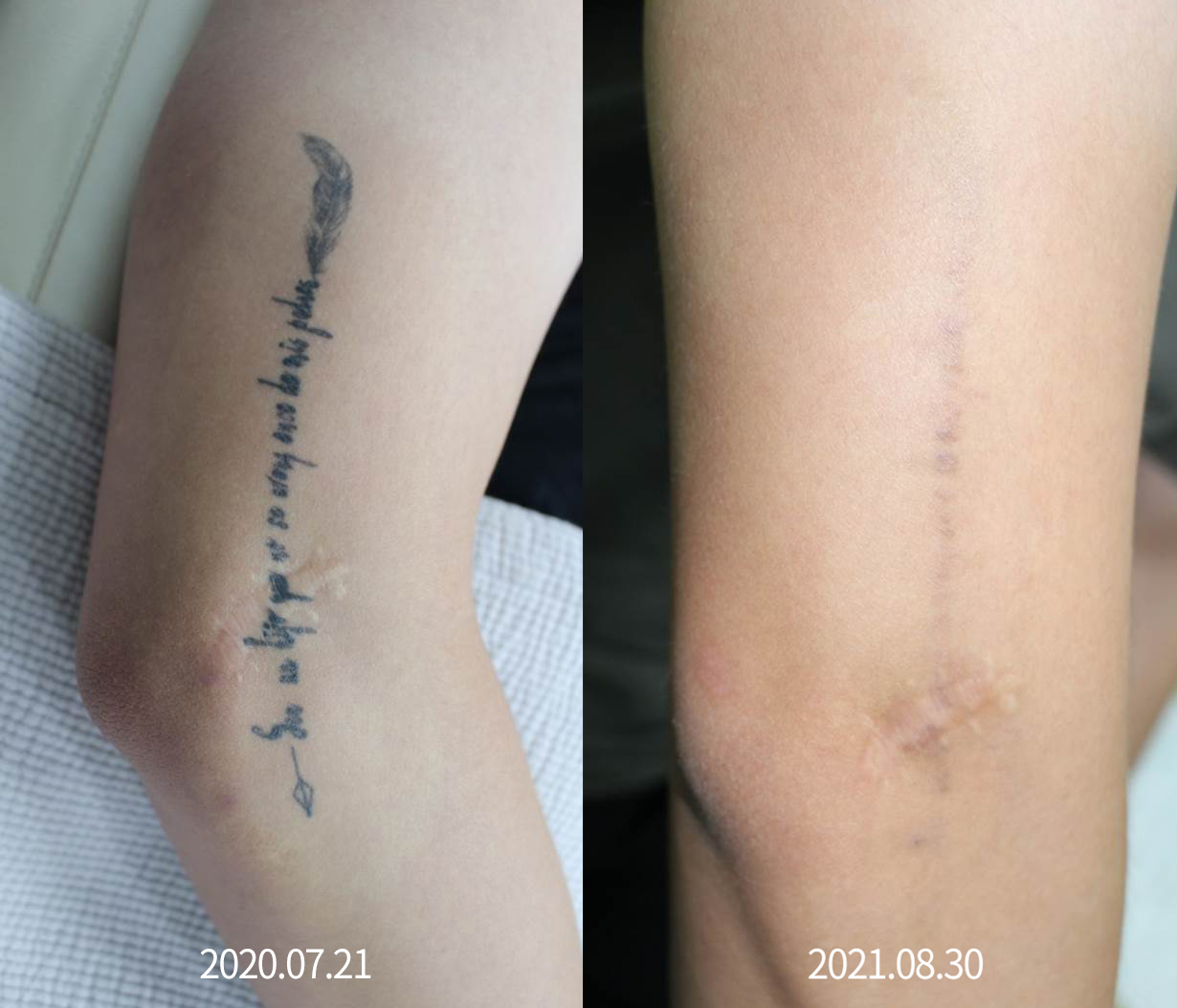 해운대 센텀 피코레이저 문신(타투)제거 후기_06.jpg