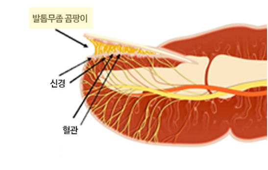 부산 노란 발톱무좀 원인 레이저치료_01.jpg