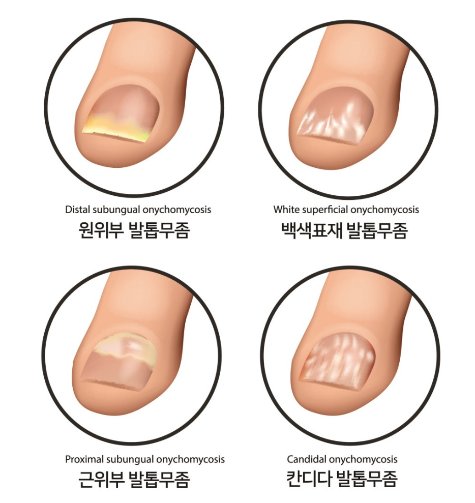 부산 노란 발톱무좀 원인 레이저치료_02.jpg