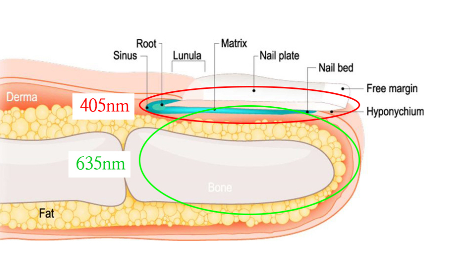 부산 노란 발톱무좀 원인 레이저치료_06.jpg