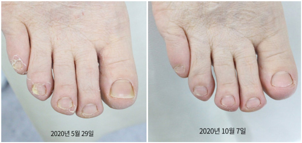 부산 노란 발톱무좀 원인 레이저치료_03.jpg