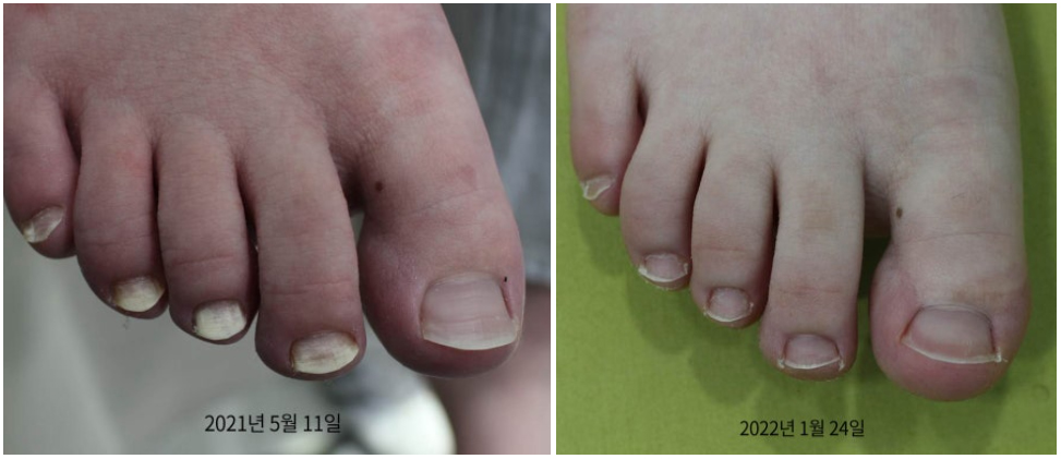 부산 노란 발톱무좀 원인 레이저치료_04.jpg