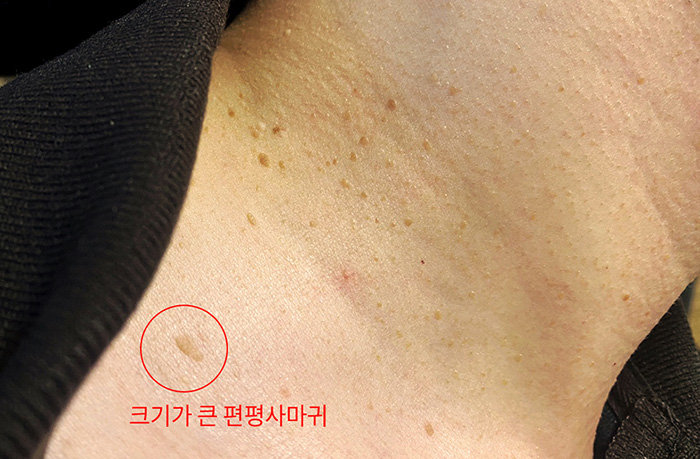 부산-색깔있는-얼굴-편평사마귀-제거_03.jpg