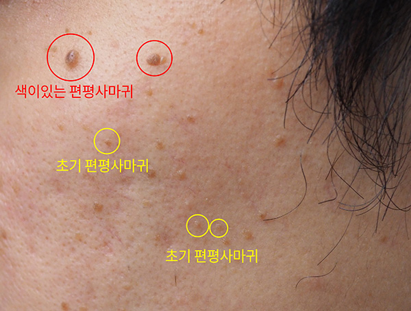 부산-색깔있는-얼굴-편평사마귀-제거_01.jpg