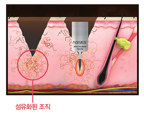 부산-코여드름-치료-아그네스-니들고주파_03.jpg