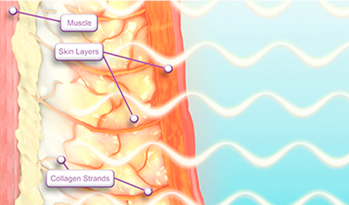 부산 고주파리프팅 VS 초음파리프팅_03.jpg