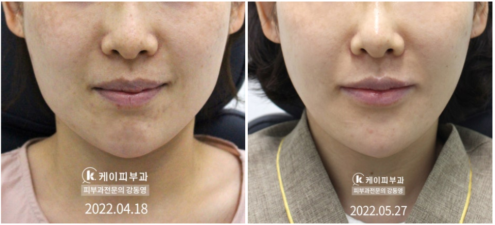 부산 고주파리프팅 VS 초음파리프팅_10.jpg