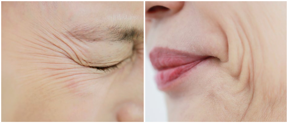 부산 고주파리프팅 VS 초음파리프팅_08.jpg