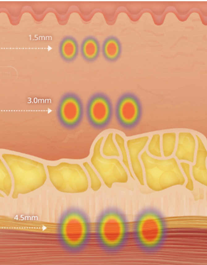 부산 고주파리프팅 VS 초음파리프팅_06.jpg