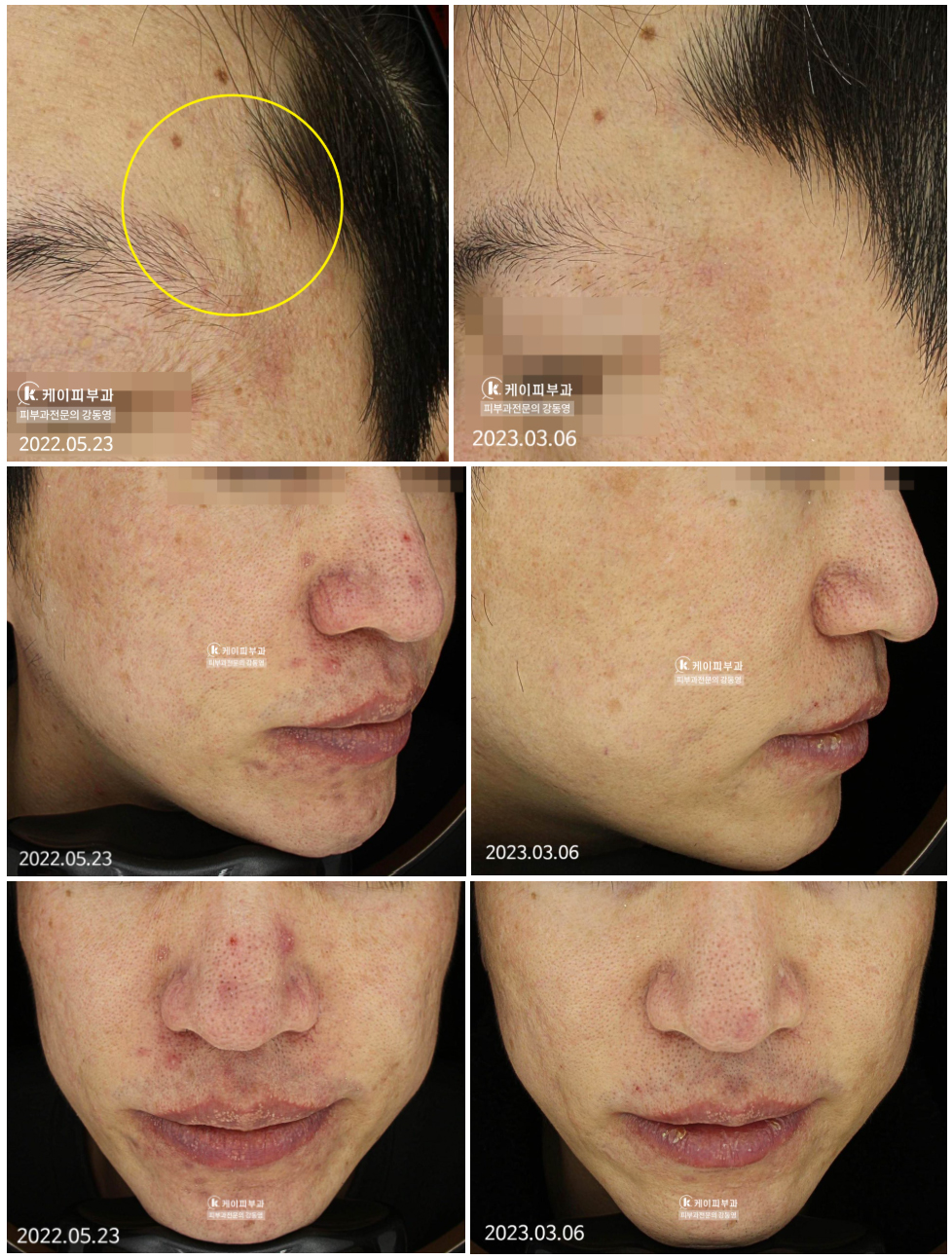 부산 여드름흉터 안면홍조 치료 후기_03.jpg