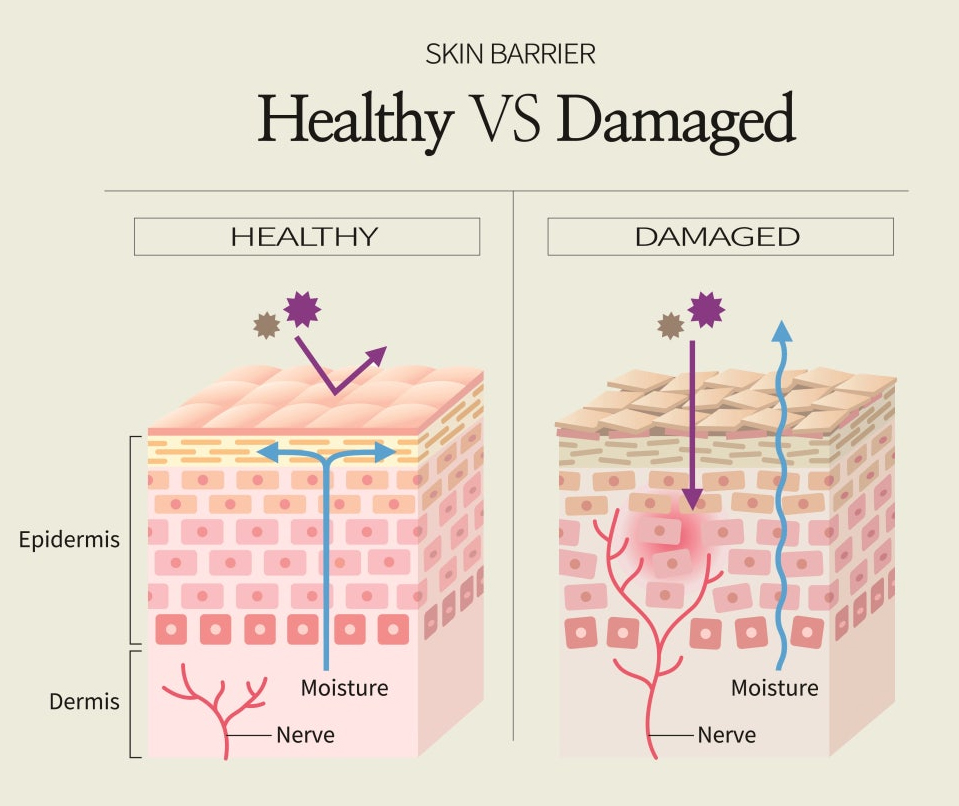 부산 여드름흉터 안면홍조 치료 후기_07.jpg