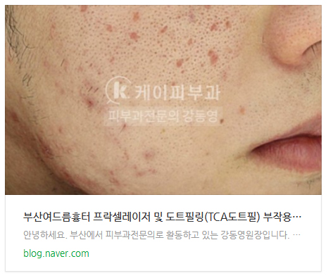 부산 여드름흉터 안면홍조 치료 후기_02.jpg