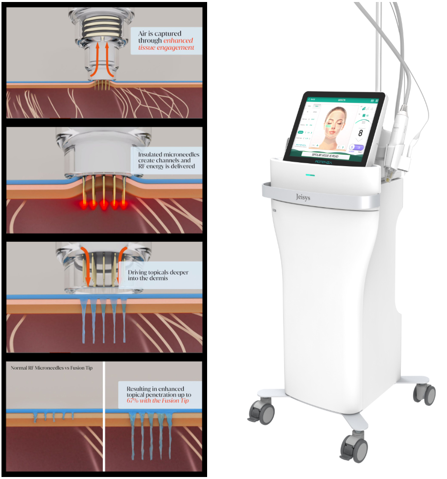 부산 여드름흉터 안면홍조 치료 후기_04.jpg