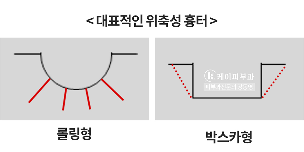 부산 여드름흉터 안면홍조 치료 후기_01.jpg