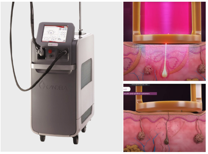 부산 레이저 부작용 치료_겨드랑이 색소침착_02.jpg