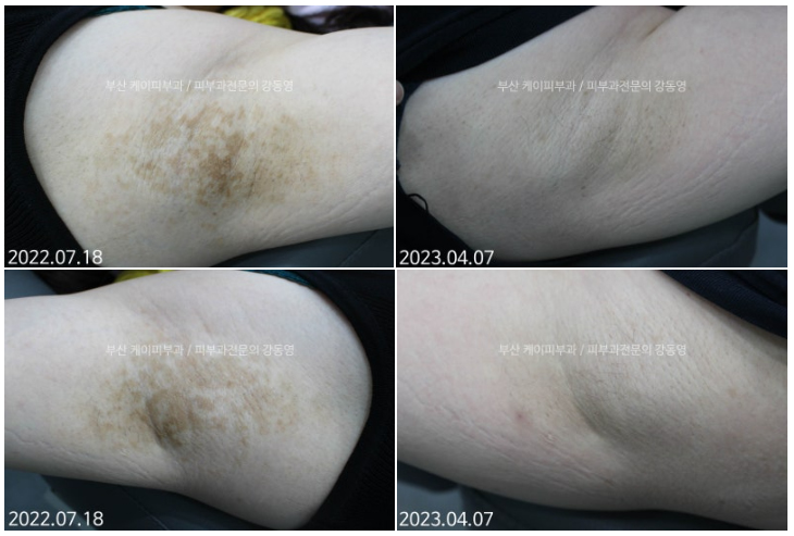 부산 레이저 부작용 치료_겨드랑이 색소침착_04.jpg