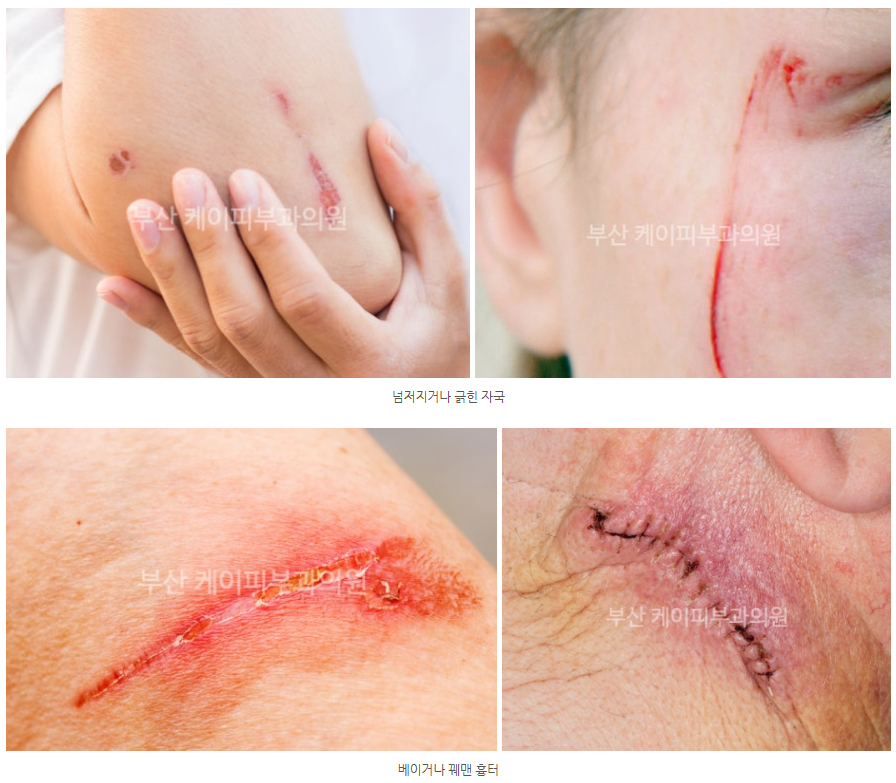 이마에 긁힌 자국 레이저 흉터치료_01.jpg