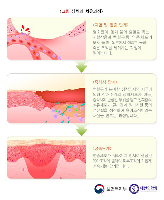 이마에 긁힌 자국 레이저 흉터치료_02.jpg