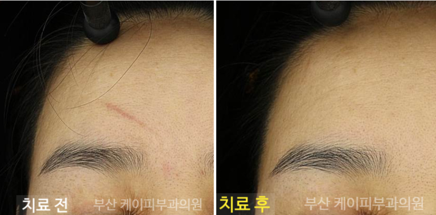 이마에 긁힌 자국 레이저 흉터치료_06.jpg